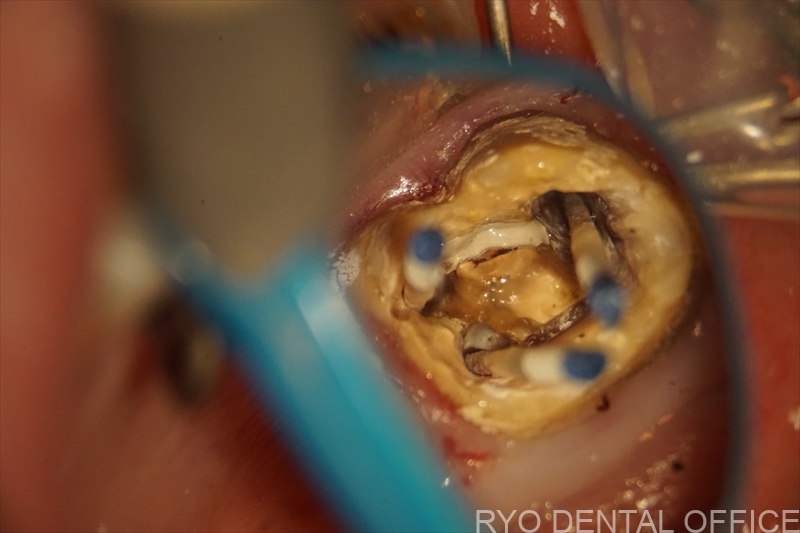 顕微鏡根管治療症例