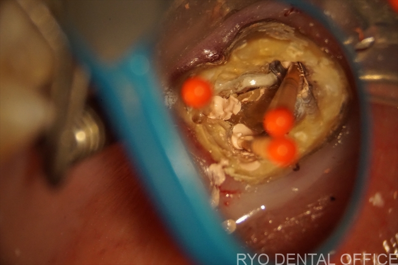 顕微鏡根管治療症例