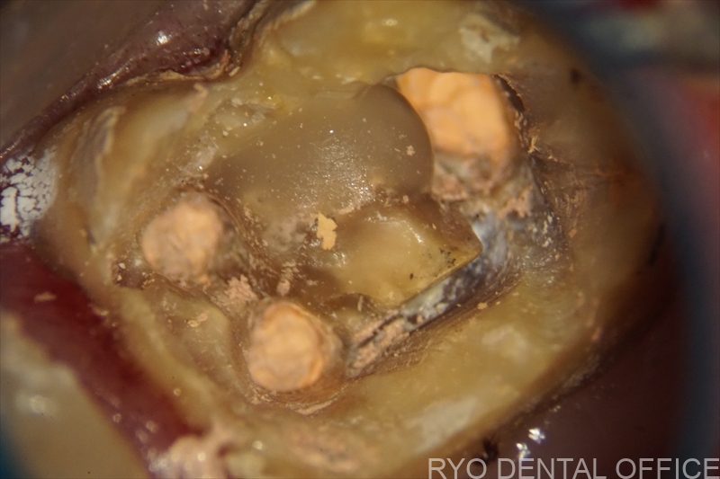 顕微鏡根管治療症例