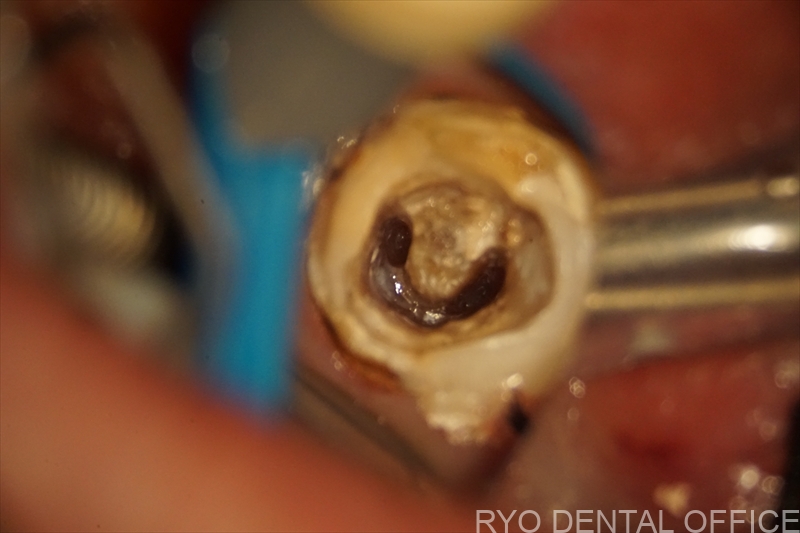 顕微鏡根管治療症例