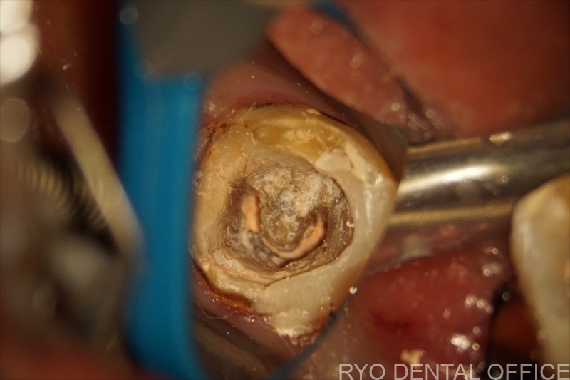 顕微鏡根管治療症例