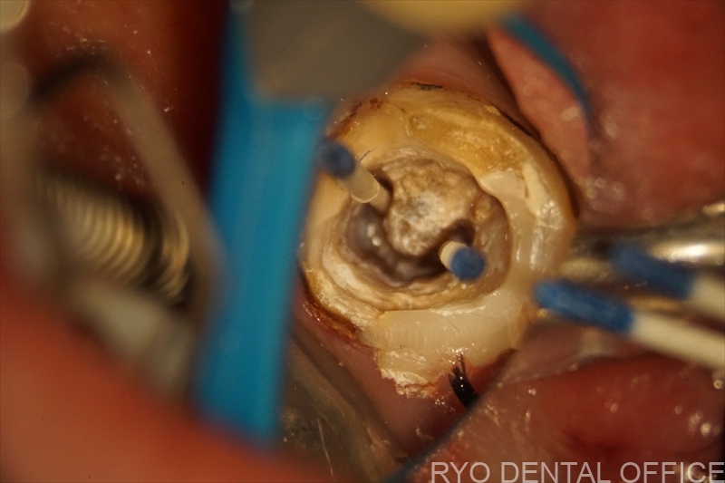 顕微鏡根管治療症例