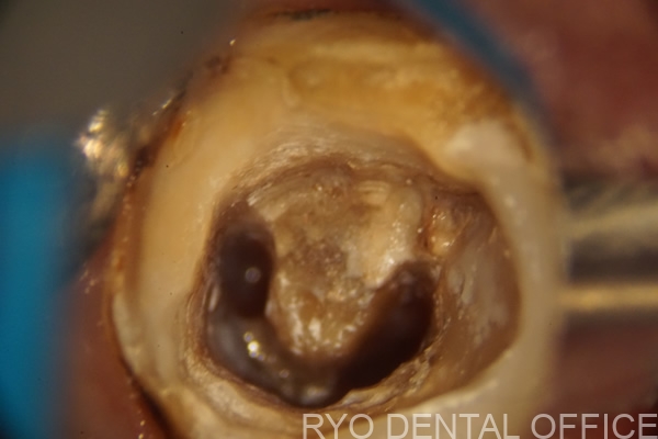 膿んでしまった歯の顕微鏡根管治療例｜T.M42歳女性