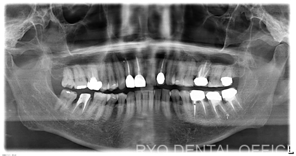 顕微鏡根管治療後レントゲン写真