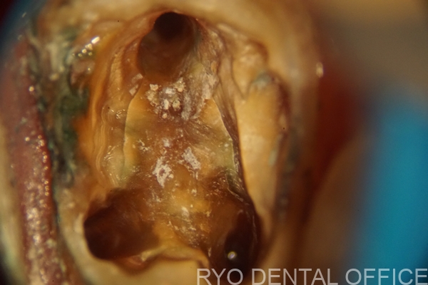 根管治療の精密さを欠き再発。膿んだ歯の顕微鏡根管治療例｜M.H69歳男性