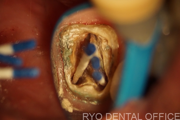 顕微鏡根管治療中(無菌乾燥中)