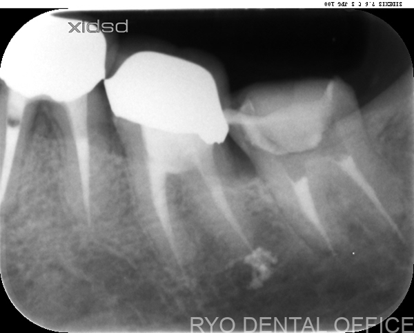 顕微鏡根管治療後
