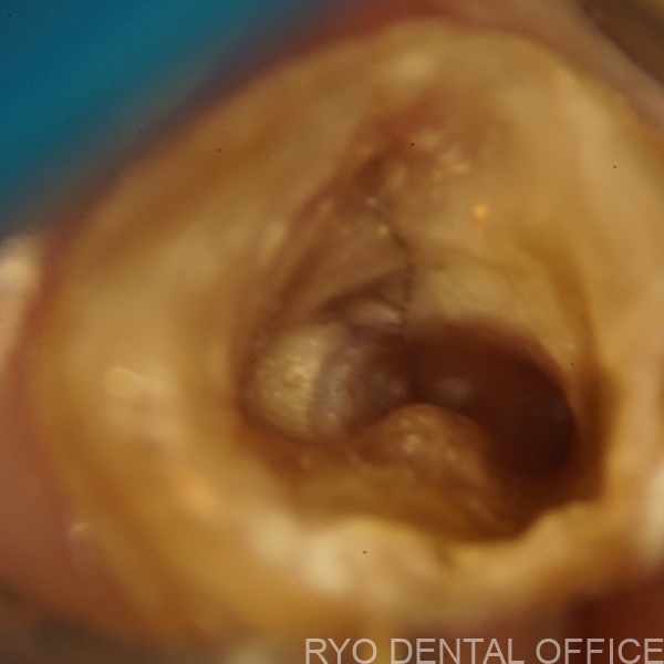 治療中断し放置した歯が再発。顕微鏡を使用した再根管治療例｜M.M50歳女性