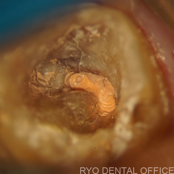 顕微鏡根管治療後