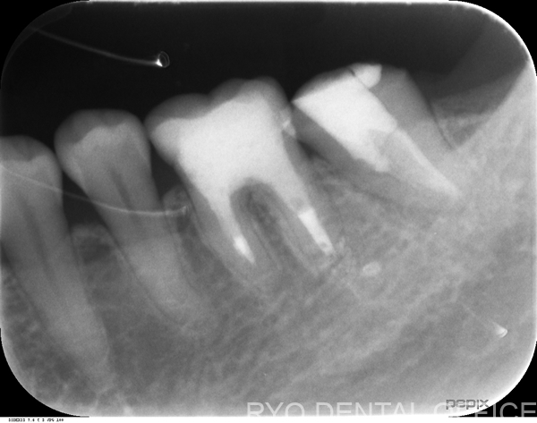 顕微鏡根管治療前