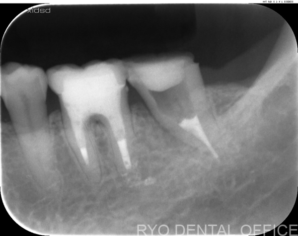 顕微鏡根管治療後