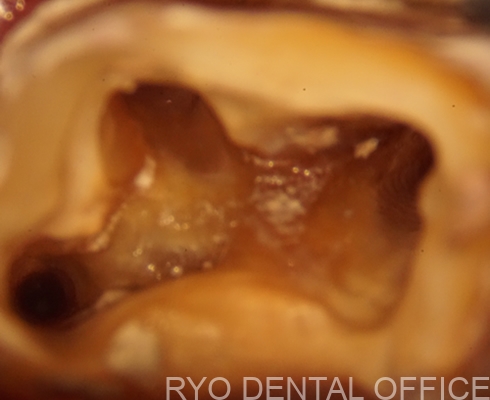 精細さ欠いた根管治療を顕微鏡で再根管治療例｜M.Y56歳男性