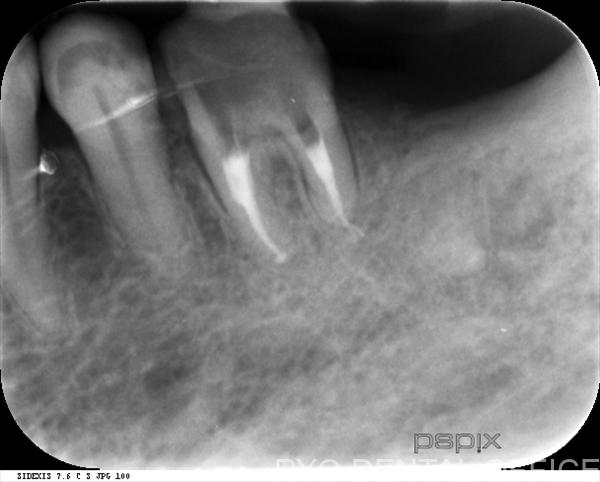 左下6番の顕微鏡根管治療後
