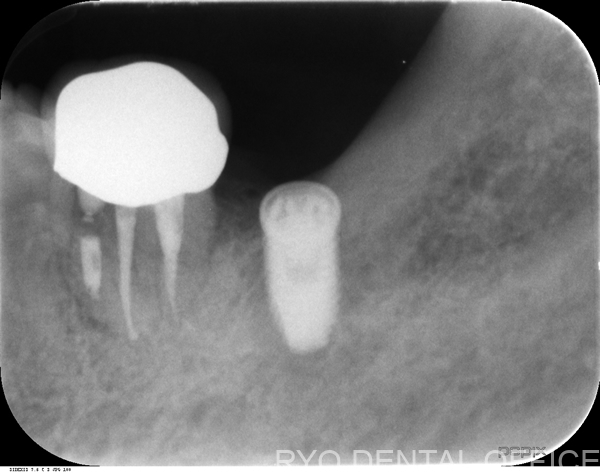 左下6番の顕微鏡根管治療後
