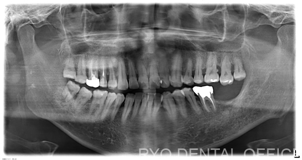 顕微鏡根管治療前のレントゲン画像