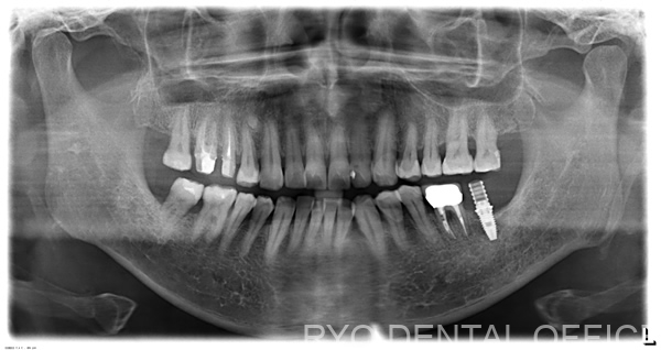 顕微鏡根管治療後のレントゲン画像
