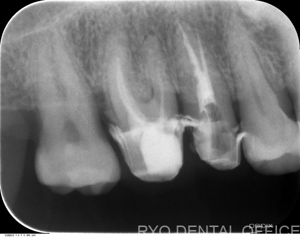 右上6番の顕微鏡根管治療前レントゲン画像