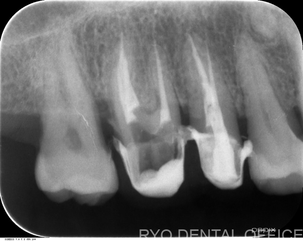 右上6番の顕微鏡根管治療後レントゲン画像