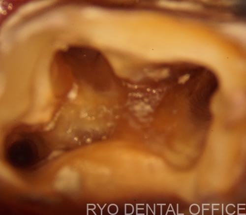 右上6番の顕微鏡根管治療前画像